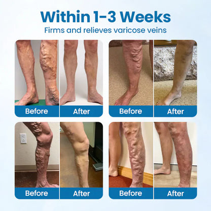 LBMLBM® VeinGuard Herbal Spray-✅ Clinically proven to eliminate varicose veins in just 7 days!